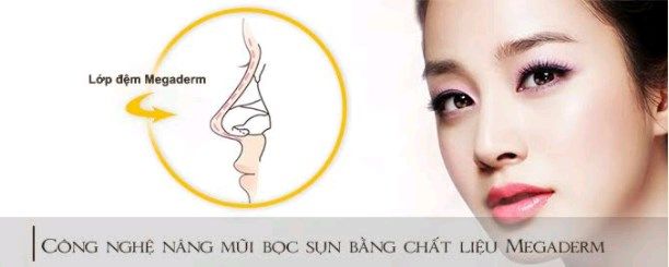 Megaderm là gì? Liệu có phải là giải pháp thần thánh khi nâng mũi