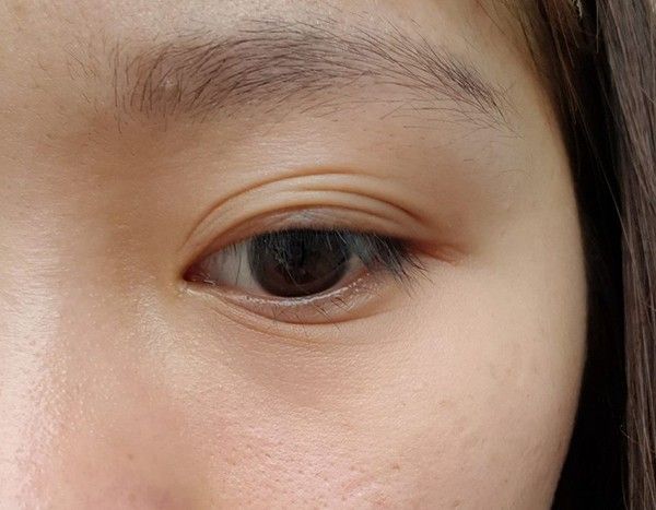 Mắt 3 mí: nguyên nhân và cách khắc phục?