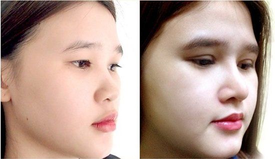 Mũi ngắn, hếch nên khắc phục bằng phương pháp nâng mũi nào?