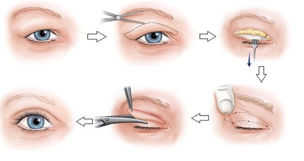 Chi tiết về cắt mí trên, bạn đã biết?