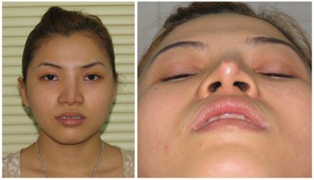 Sau nâng mũi nằm nghiêng có bị lệch mũi không?