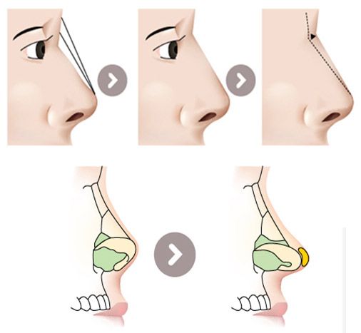 Tuyệt đối không được nâng mũi quá cao – lý do vì sao?