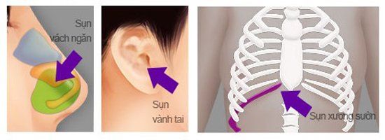 Sụn sườn có bị co ngót và teo đi sau khi nâng mũi không?