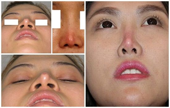 Chỉnh sửa mũi hỏng sau nâng mất bao lâu mới bình thường trở lại?