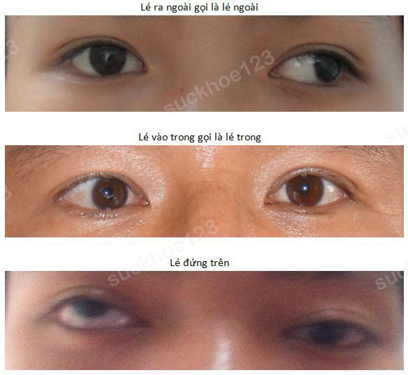 Mắt lé: bấm mí, cắt mí có khắc phục được không?