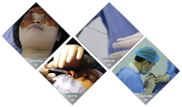 Treo cánh mũi bằng chỉ không tiêu: nên hay không?