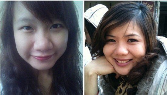 Tìm hiểu về kỹ thuật thu gọn chóp mũi quá khổ trong nâng mũi