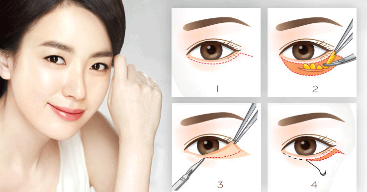 Cắt mí mắt dưới đẩy lùi bọng mắt, da thừa