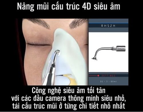 Nâng mũi cấu trúc 4D siêu âm là gì?