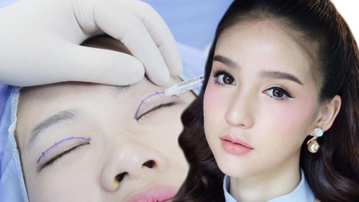 Điểm danh các phương pháp nhấn mí phổ biến trong thẩm mỹ mắt