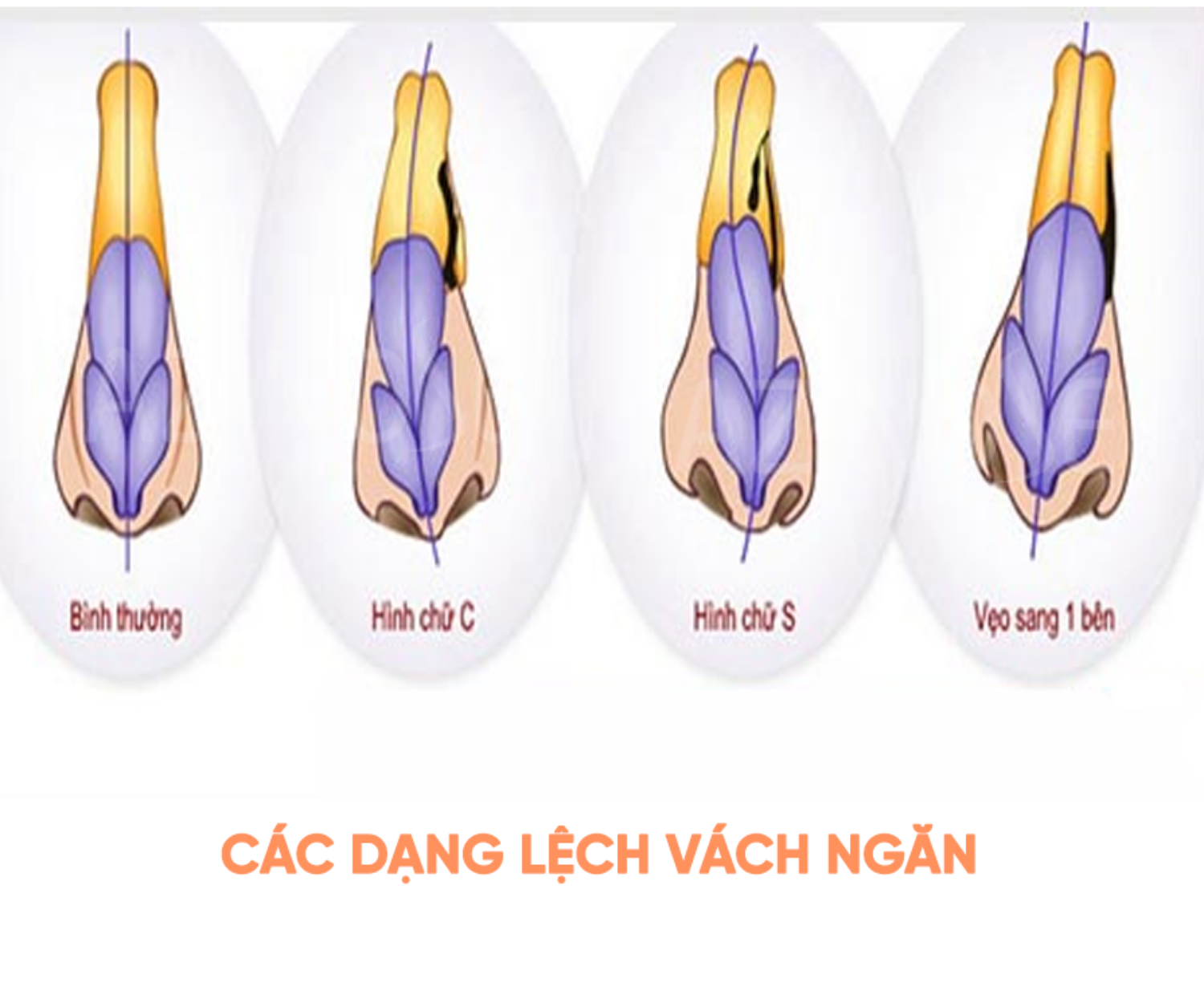 Nâng mũi cấu trúc – giải pháp hoàn hảo cho mũi lệch vách ngăn