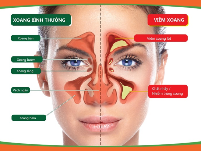 Nâng mũi giúp cải thiện tốt hơn tình trạng viêm xoang?