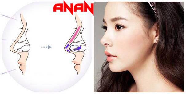 Nâng mũi L-line 2 lớp Double-L có gì khác biệt?