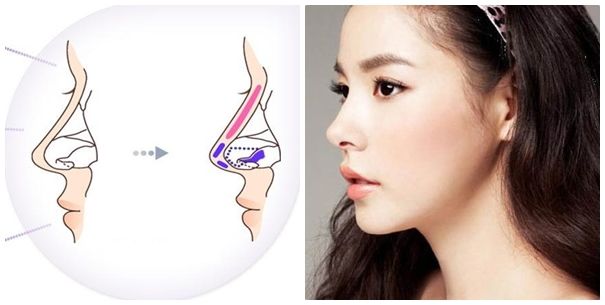 Chi phí nâng mũi và những yếu tố quyết định