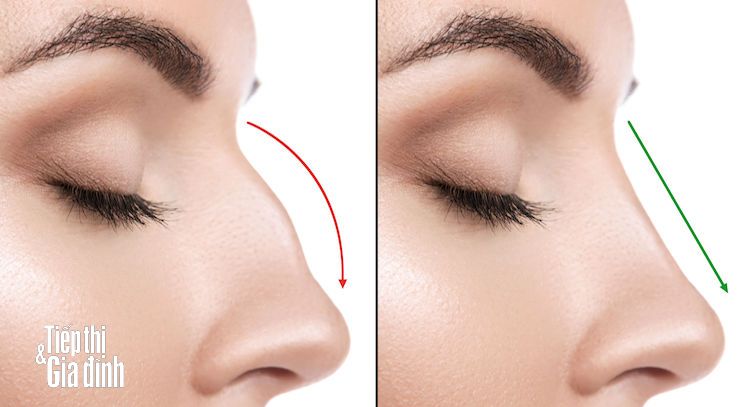 Hiểu đúng về dáng mũi L line thời thượng