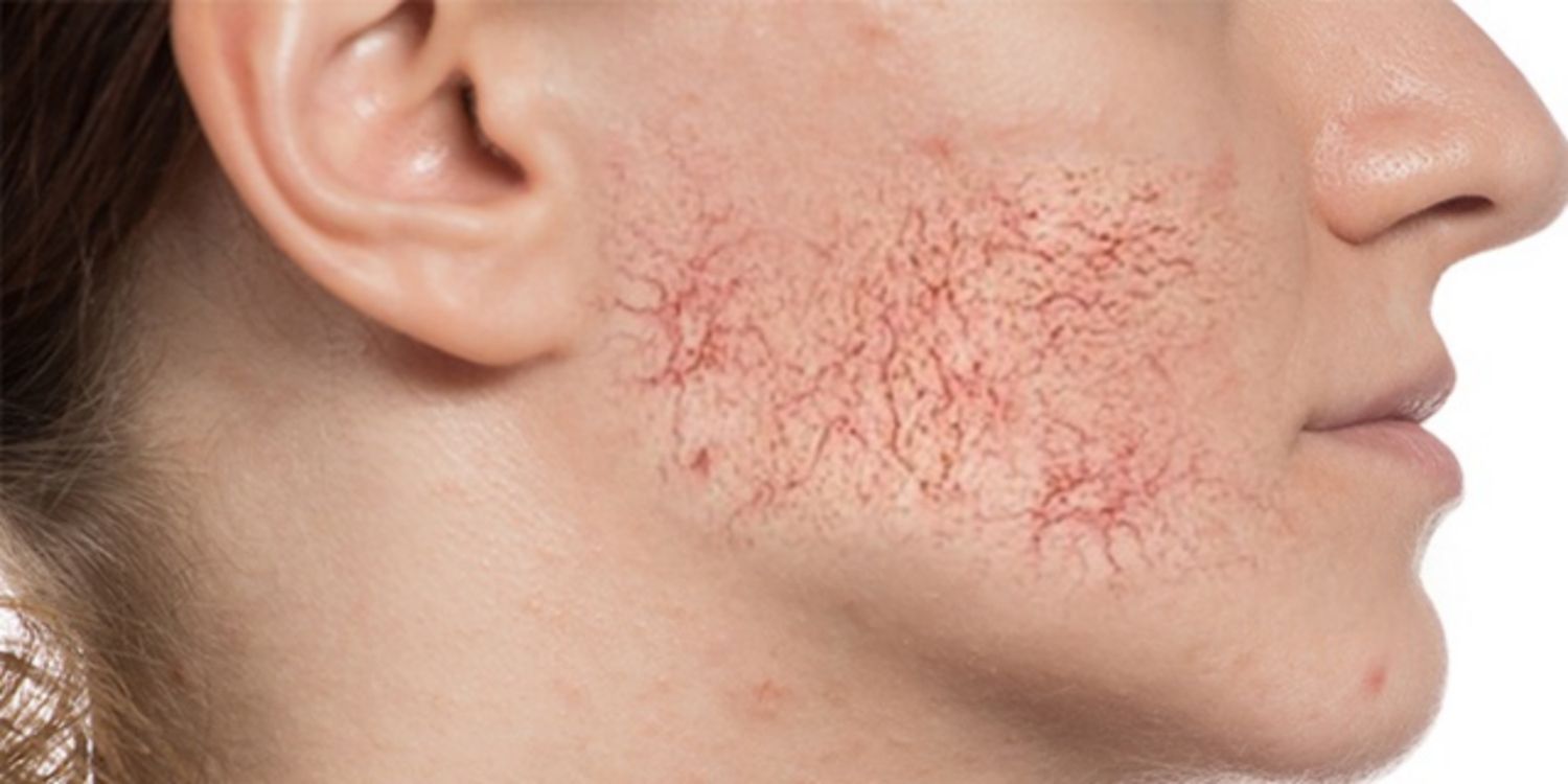 Không chỉ có chân, tĩnh mạch mạng nhện còn có thể xảy ra ở 3 vị trí này