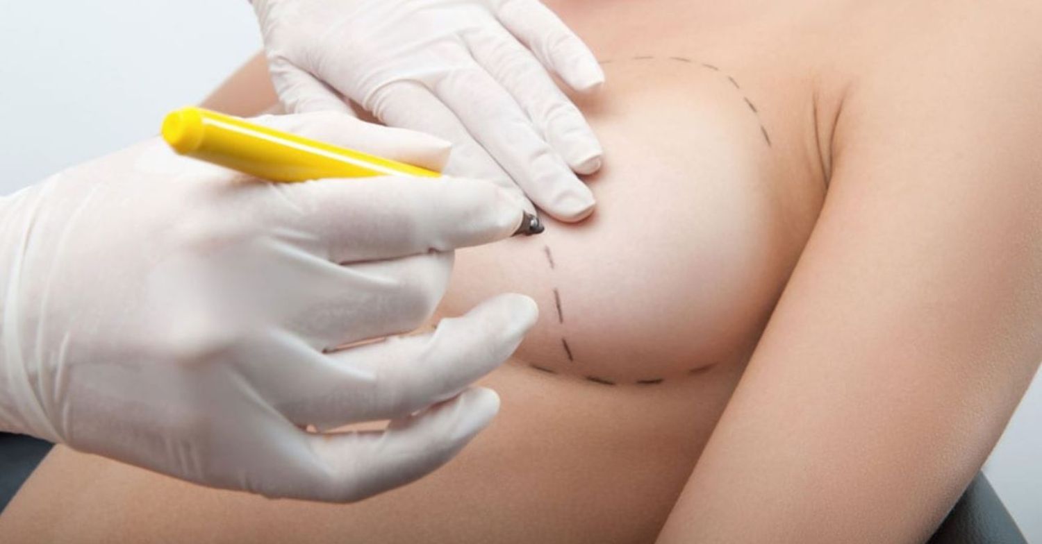 Treo ngực sa trễ kết hợp đặt túi độn