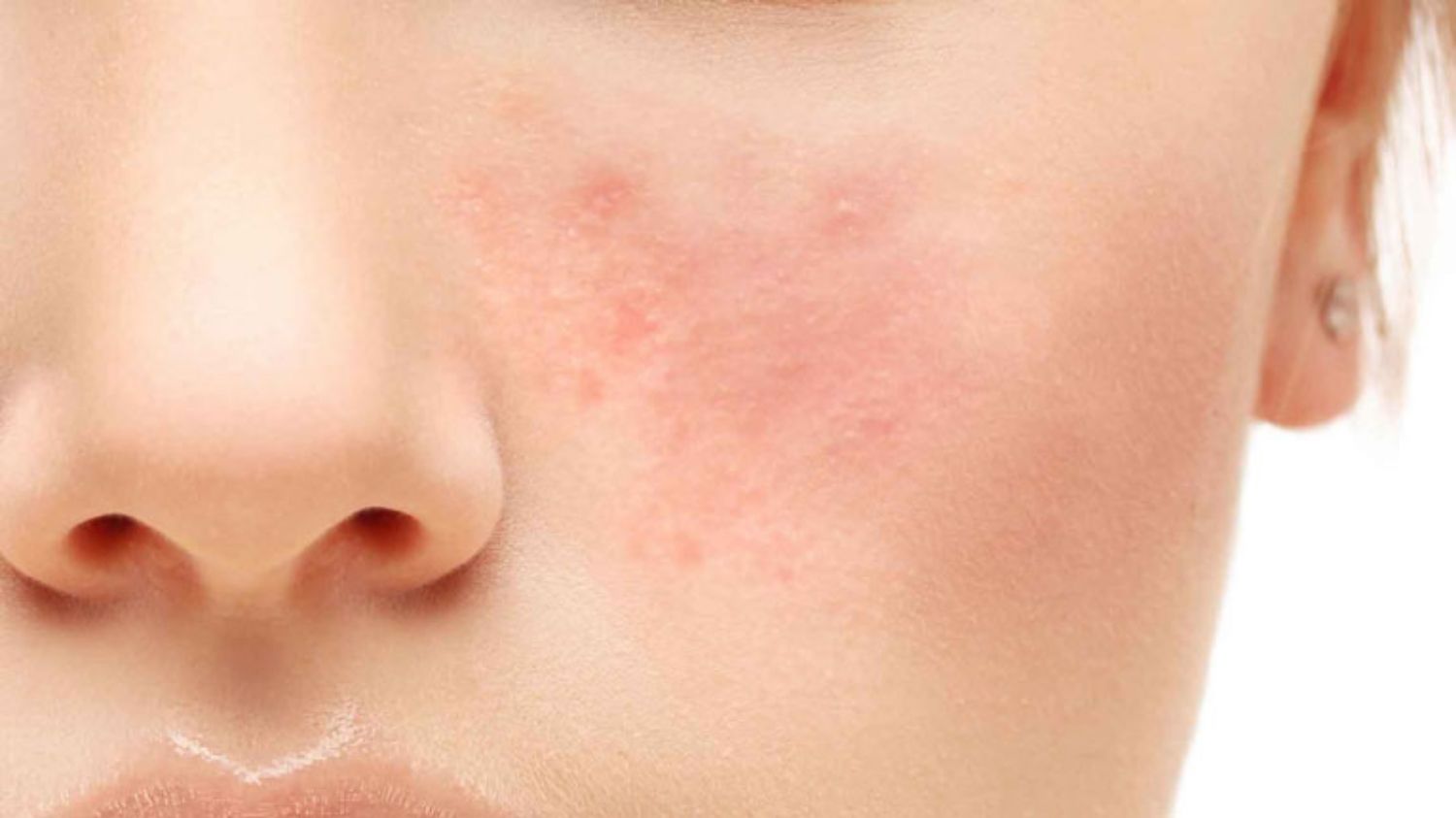 Chữa bệnh trứng cá đỏ bằng isotretinoin