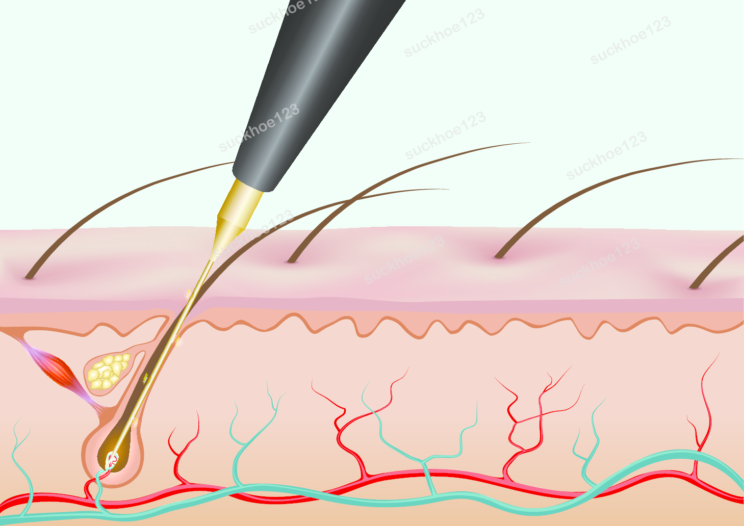 Triệt lông vĩnh viễn bằng điện phân Electrolysis