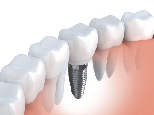trong rang implant
