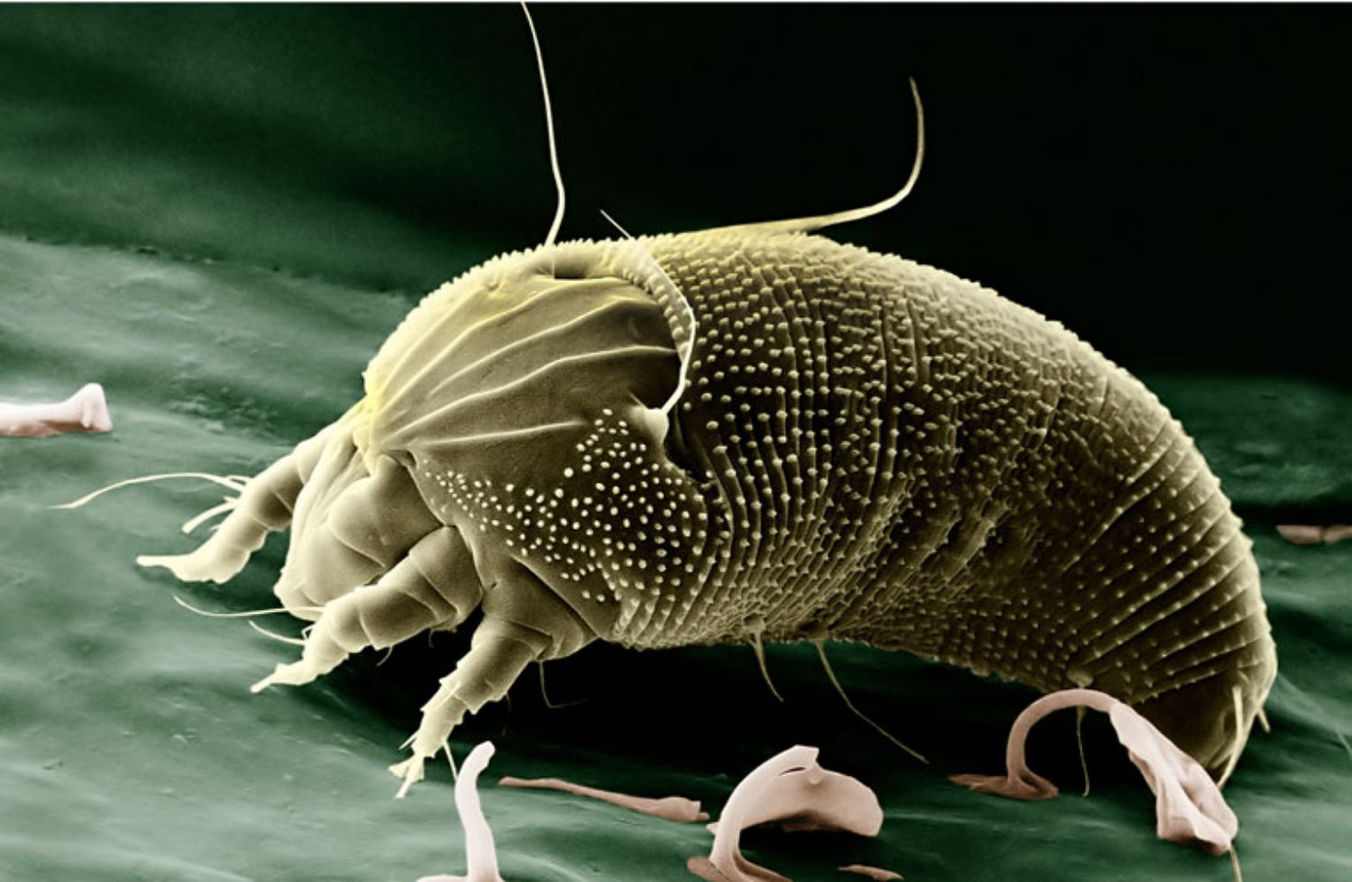Bệnh trứng cá đỏ và kí sinh trùng Demodex