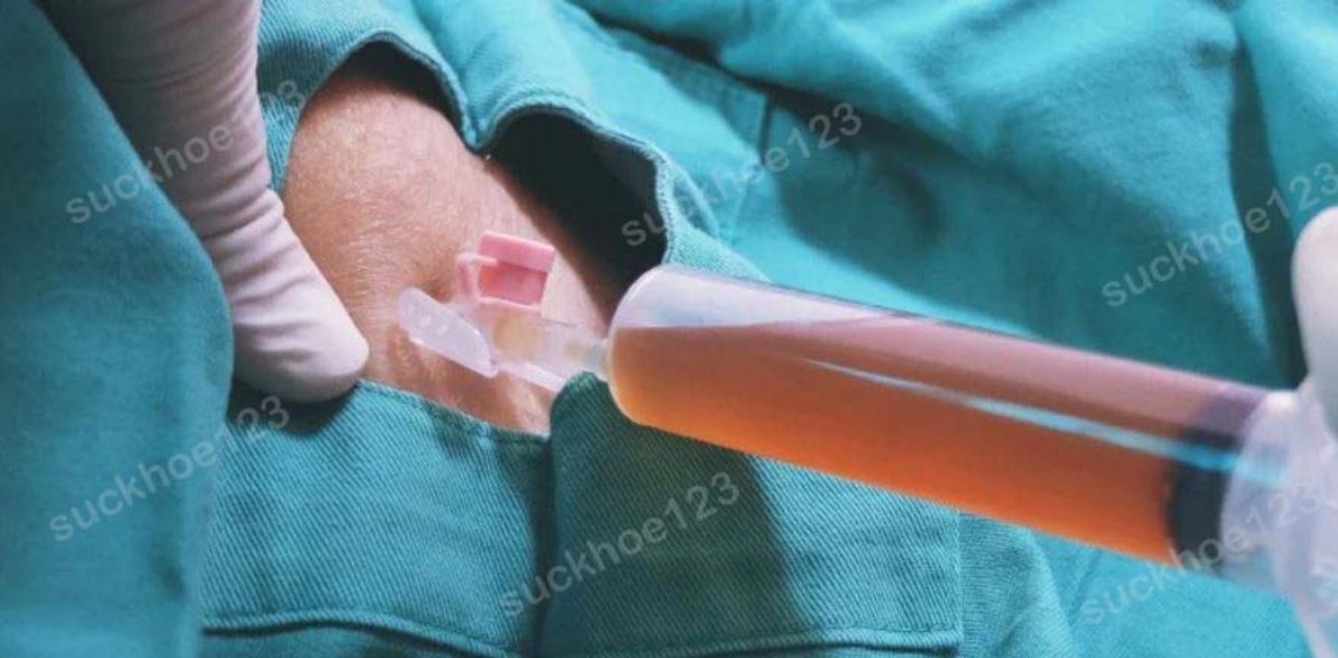 Tụ dịch sau hút mỡ: nguyên nhân và cách xử lý