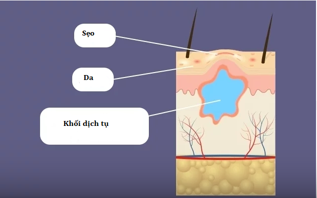 Tụ dịch sau phẫu thuật thẩm mỹ