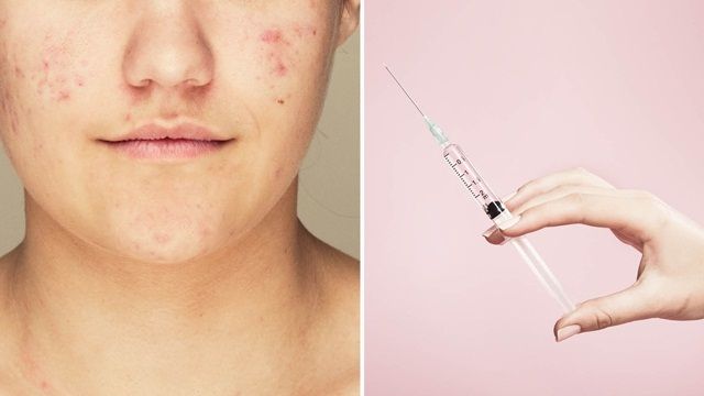 Sắp có vắc-xin ngừa mụn trứng cá