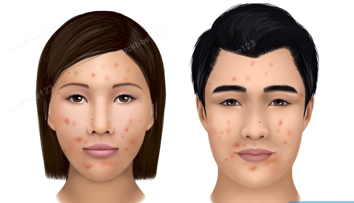 Cách Trị Vết Thâm Sau Mụn Không Phải Ai Cũng Biết