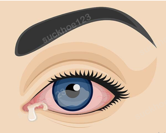 Viêm giác mạc sau phẫu thuật sụp mi