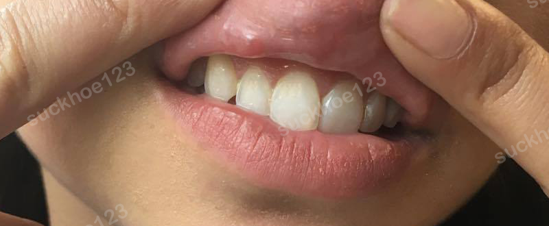 Nổi cục cứng, vón cục sau tiêm filler