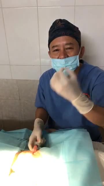 Chuyển mỡ vùng bụng lên vùng mặt