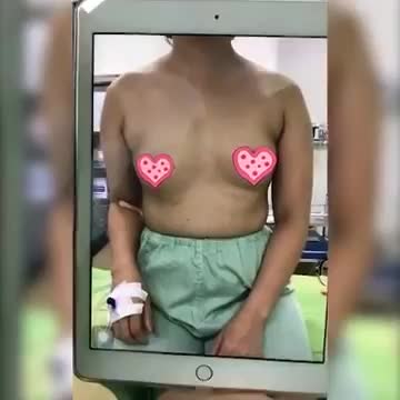 Nâng ngực trên KH 32 tuổi
