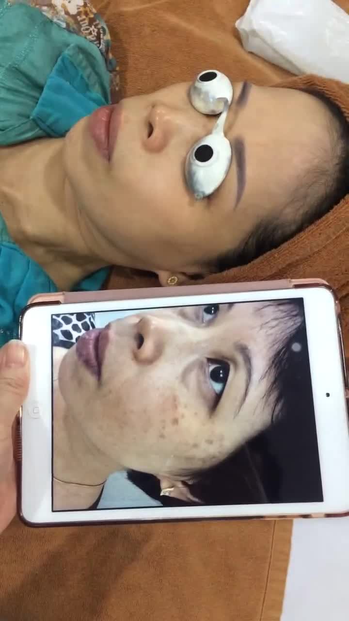 Liệu trình trị nám, tàn nhang