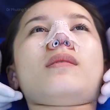 Hướng dẫn cách chăm sóc sau nâng mũi (p.3)