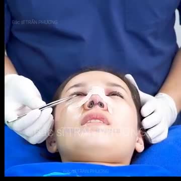 Tiếp tục câu chuyện nâng mũi của bạn Thương (p.4)