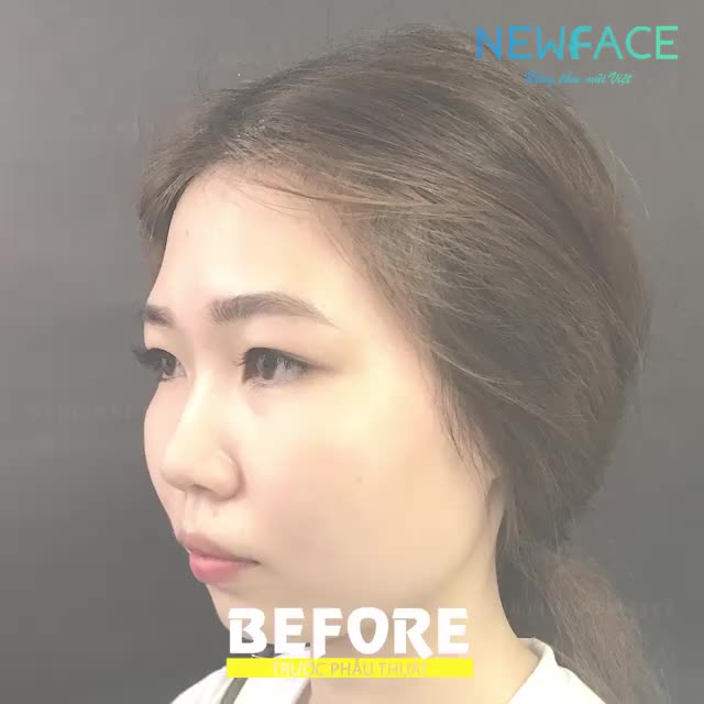 Nâng mũi trên bạn gái ở Long An