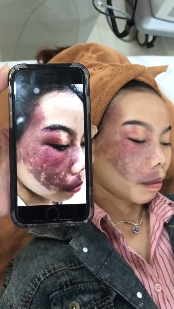 Điều trị bớt sắc tố buổi thứ 3 trên KH 20 tuổi