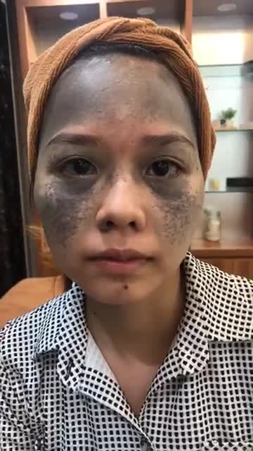 Điều trị bớt Ota bẩm sinh bằng công nghệ laser