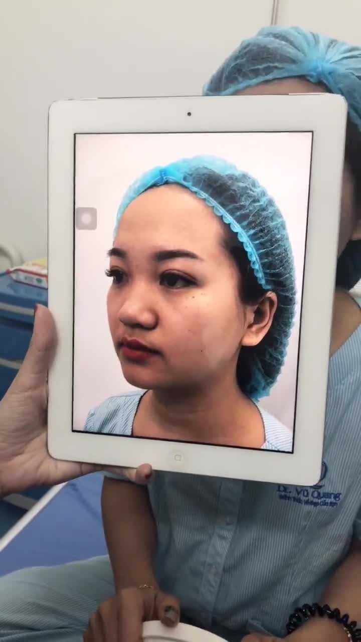 Nâng mũi trên KH có gương mặt tròn
