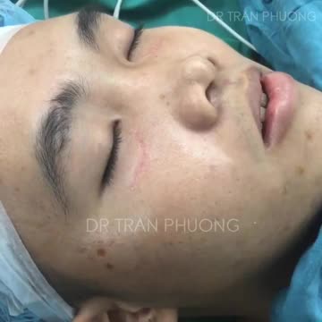 Nâng mũi sụn sườn cho một bạn nam (p1- chuẩn bị)