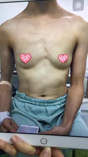 Nâng ngực túi độn size 300 cc