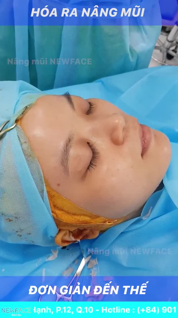 Hóa ra nâng mũi đơn giản thế!