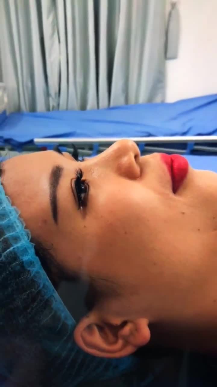 Tạo hình mũi bán cấu trúc