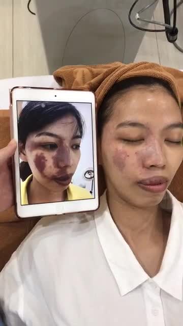 Kết quả sau 2-3 liệu trình điều trị u máu