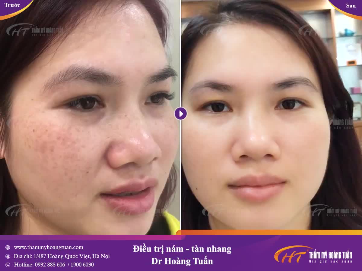 Đừng hiểu nhầm nám nhẹ là nám dễ chữa