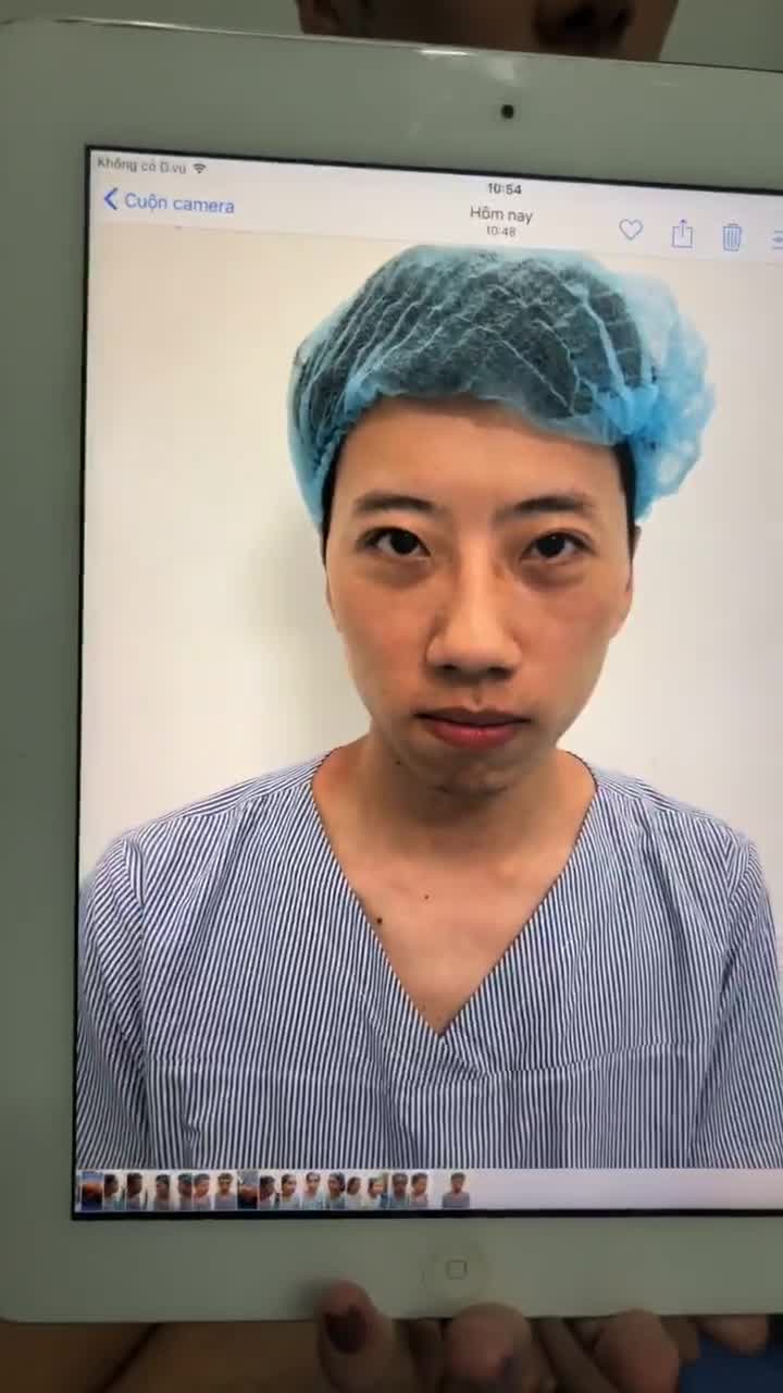 KH nam (Trung Quốc) thực hiện combo mắt - mũi - cằm cùng lúc
