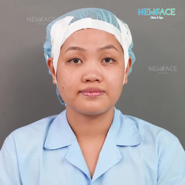 Nâng mũi có kèm phủ mô da nhân tạo