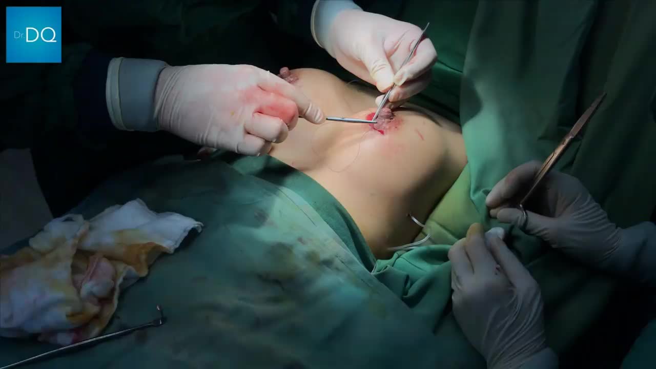 Nâng ngực qua đường quầng vú