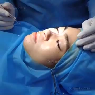 Nâng mũi bằng Gortex